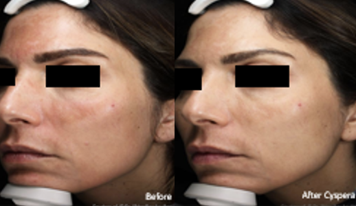 Cyspera Intensive™